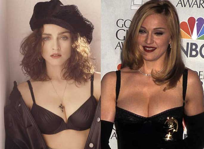 Madonna Breast Implant