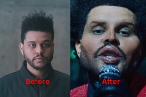 The Weeknd Plastic Surgery